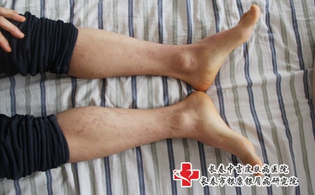孩子得了银屑病应该用什么药，长春治疗牛皮癣有什么好办法