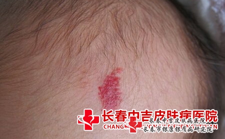 红胎记有什么影响，吉林好的胎记医院怎样能去红胎记