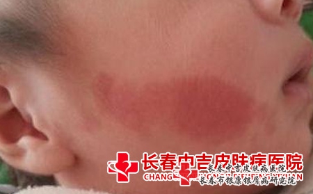 去红胎记的方法，长春专业胎记医院排名