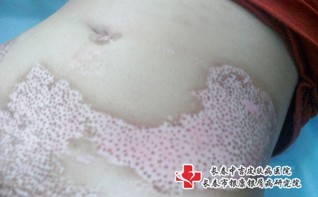 白癜风多久能好，长春治疗白癜风的医院