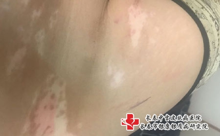 治疗白癜风应该注意什么，长春去哪个治白癜风专业
