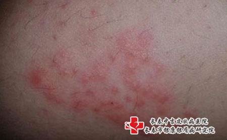 30换季容易过敏瘙痒怎么办，长春哪个皮肤病医院好