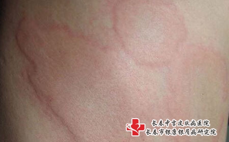 得了荨麻疹怎么办，长春治疗荨麻疹要花多少钱