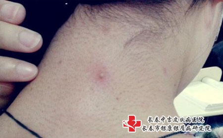 患有青春痘要怎么办才好，长春哪个医院治青春痘好