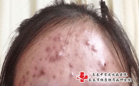 青春痘的诊治费用，看青春痘选择长春中吉皮肤病医院