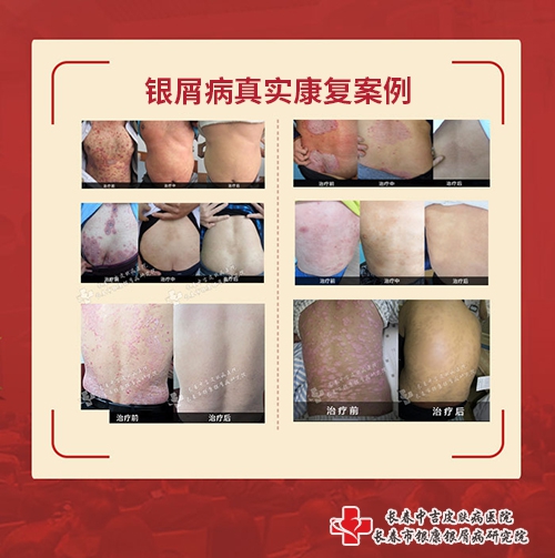长春中吉皮肤病医院银屑病康复案例 长春中吉皮肤病医院银屑病康复案例