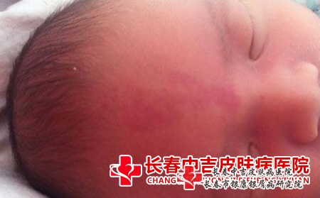 宝宝脸上的红胎记怎么办，长春好的胎记医院看中吉
