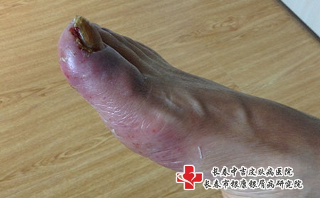 得了湿疹怎么办，长春哪个治湿疹的医院口碑好?