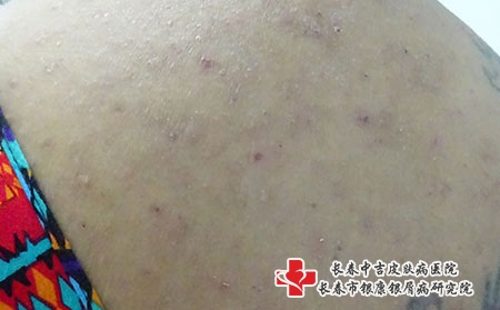 缓解湿疹的方法，长春去哪个医院治湿疹好