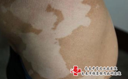 白癜风患者的临床表现，长春哪个医院看白癜风好?