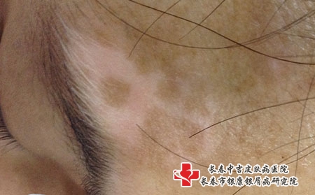白癜风引起的并发症，长春哪个医院看白癜风?