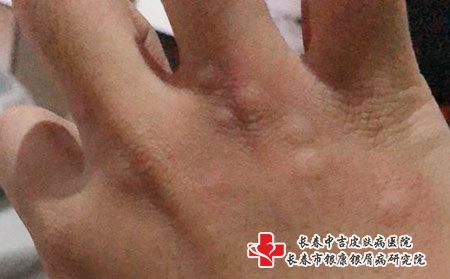 如何护理荨麻疹比较好，长春哪个荨麻疹医院口碑好?