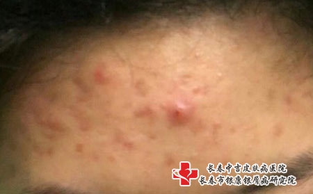 额头上长青春痘的原因，长春哪个医院治痤疮好?