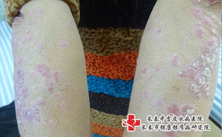 如何选择医院治疗银屑病，长春治疗牛皮癣的中医院?