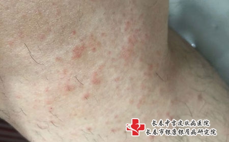 夏季该如何预防皮炎，长春看皮炎去哪个医院
