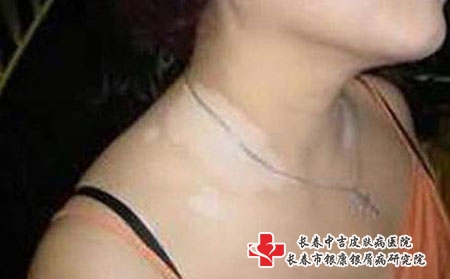 得了白癜风怎么办，长春哪个医院治白癜风好一点 