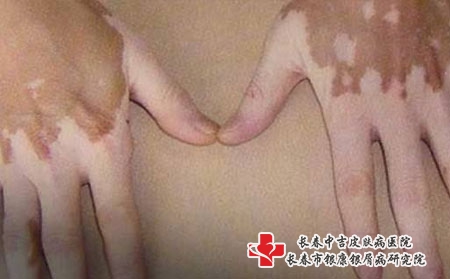 哪些原因会导致白癜风的产生，长春哪个医院看白癜风好?