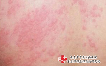 皮肤爱过敏怎么办_长春哪个医院看皮肤过敏的好?