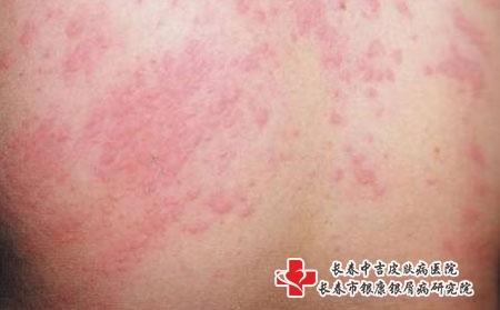 皮肤过敏的诱因是什么，长春哪所医院看皮肤过敏?