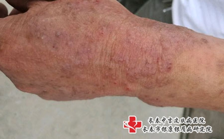 皮肤过敏不及时治疗的危害,长春哪里看皮肤过敏好? 皮肤过敏不及时治疗的危害,长春哪里看皮肤过敏好?