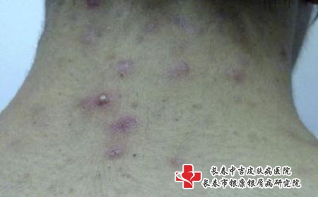 痤疮去哪治疗好_长春哪个医院治痘好?