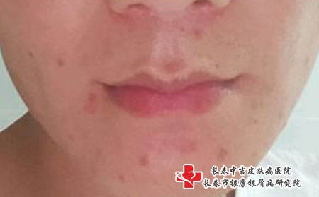 怎么做才能预防痘痘，长春看痘痘哪个医院好?