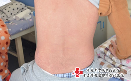 牛皮癣刚开始是什么样的-长春去哪个医院看银屑病? 牛皮癣刚开始是什么样的-长春去哪个医院看银屑病?