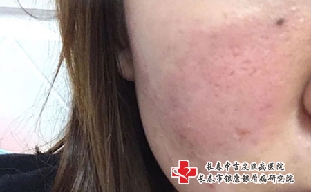得皮炎的病因-长春治疗皮炎哪所医院较好?