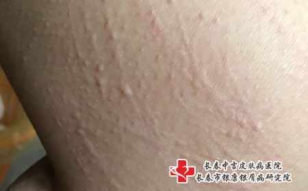 荨麻疹是什么-长春治疗荨麻疹好的医院?