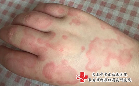 丘疹型荨麻疹有哪些症状表现，长春中吉皮肤病医院看丘疹性荨麻疹吗?