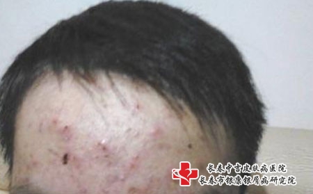 老长痘痘要怎么避免_长春治疗青春痘去哪?