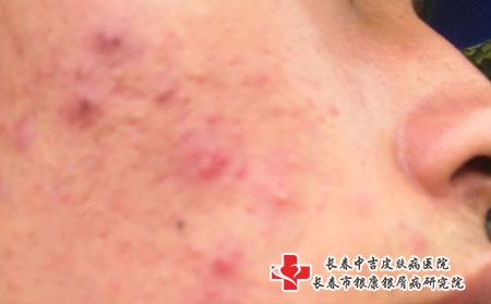长痘痘的诱因有哪些_长春治疗青春痘比较好的医院?