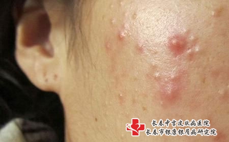 什么会引发痘痘，长春看青春痘哪个医院好?