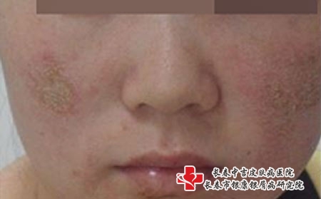 面部脂溢性皮炎的症状是什么，长春哪个医院看脂溢性皮炎?