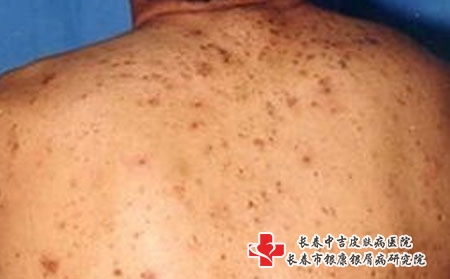 长痘痘会有什么后果-长春哪家医院治疗青春痘好?