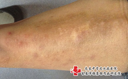 中老年湿疹怎么办-长春哪所医院看湿疹较好?