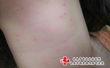 青春痘主要病因，长春哪个医院看痘痘好?