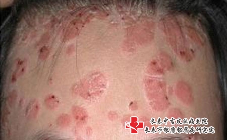 银屑病的常见病因有哪些_长春治疗牛皮癣哪里好?