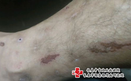 孩子脸上长接触性皮炎是什么原因，哪些会导致皮炎? 
