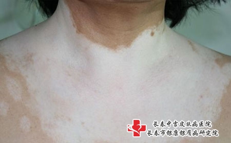 为什么胸部白癜风治的比较慢?长春治疗白癜风医院排行?