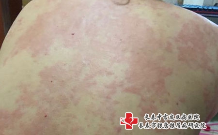 荨麻疹几个常见的发病原因-长春哪家医院治疗荨麻疹好点? 荨麻疹几个常见的发病原因-长春哪家医院治疗荨麻疹好点?
