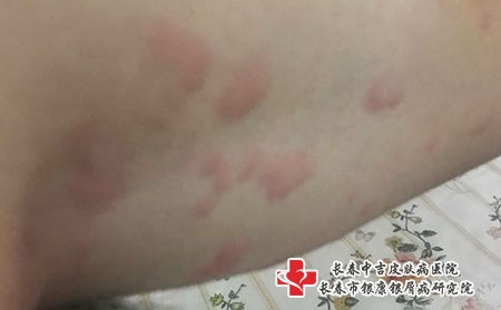 荨麻疹的病因及症状-长春哪家医院看荨麻疹? 荨麻疹的病因及症状-长春哪家医院看荨麻疹?