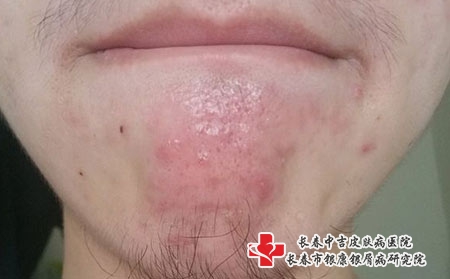 青春痘患者需要怎么办_长春哪家医院看青春痘好?