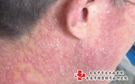 头皮银屑病怎么办呢-长春治牛皮癣较好的医院?