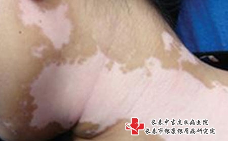 白癜风疾病的治疗怎么做比较好?长春治疗白癜风专科