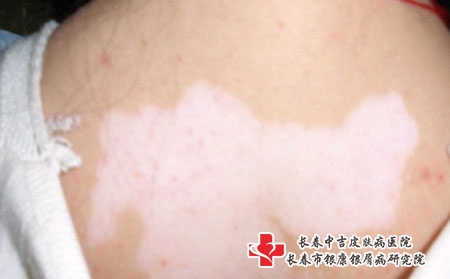 出现节段型白癜风应该如何治疗?长春白癜风哪家医院看的好