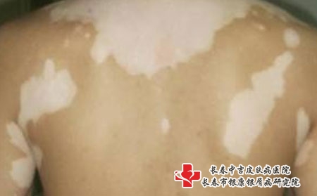 用遮盖液掩饰白癜风真的可行吗?长春治疗白癜风专科哪家好