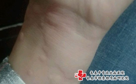 荨麻疹有哪些并发症-长春治疗荨麻疹的好医院? 荨麻疹有哪些并发症-长春治疗荨麻疹的好医院?
