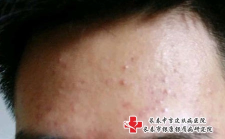 几种因素了引起额头长痘痘-长春去哪儿看青春痘?