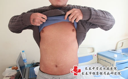 银屑病能治好要多久，长春治疗皮肤起皮的医院那家好?